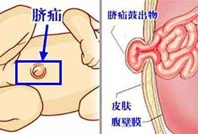 宝宝满月，宝宝刚满月,脐疝严重怎么办图1